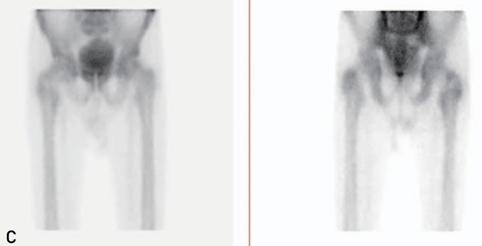 为什么需要警惕“孤立性股骨大转子骨折”？