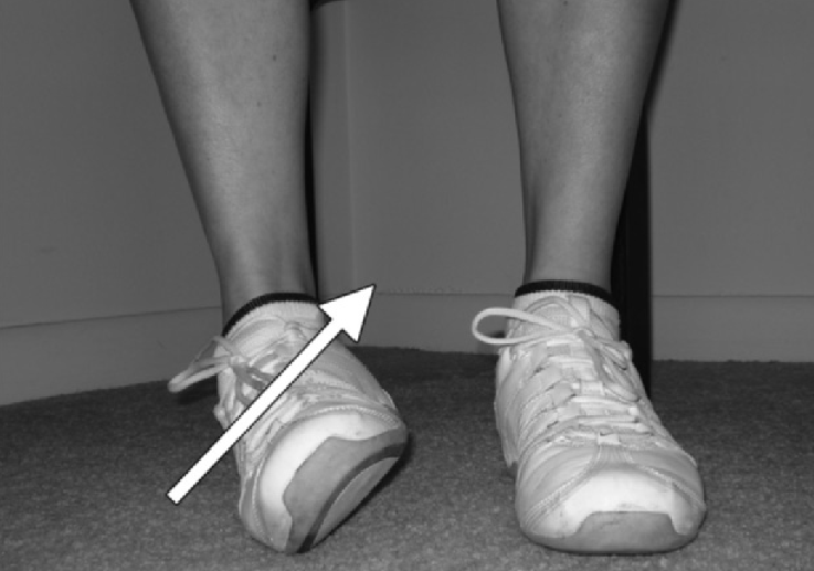 下胫腓联合损伤最全攻略｜解剖、生物力学、影像检查与术后评估