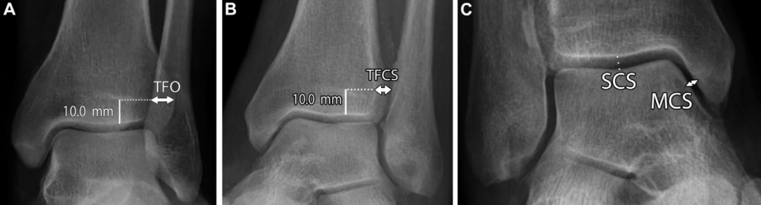 下胫腓联合损伤最全攻略｜解剖、生物力学、影像检查与术后评估