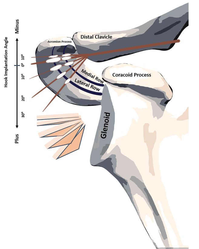 锁骨钩钢板怎么放？偏前