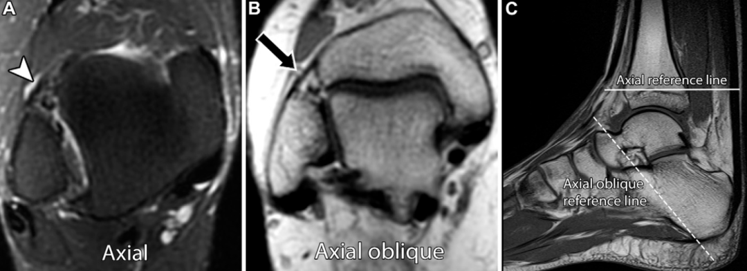 下胫腓联合损伤最全攻略｜解剖、生物力学、影像检查与术后评估