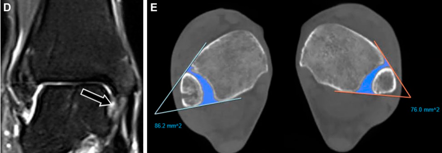 下胫腓联合损伤最全攻略｜解剖、生物力学、影像检查与术后评估