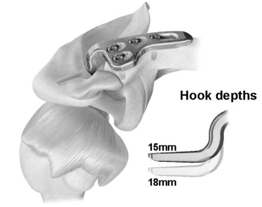 锁骨钩钢板怎么放？偏前