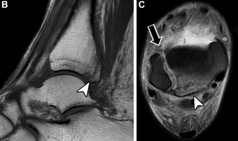 下胫腓联合损伤最全攻略｜解剖、生物力学、影像检查与术后评估
