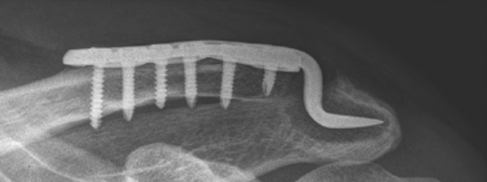 锁骨钩钢板怎么放？偏前
