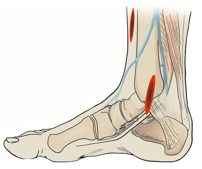 复杂Pilon骨折：“四原则”与“四步定基法”