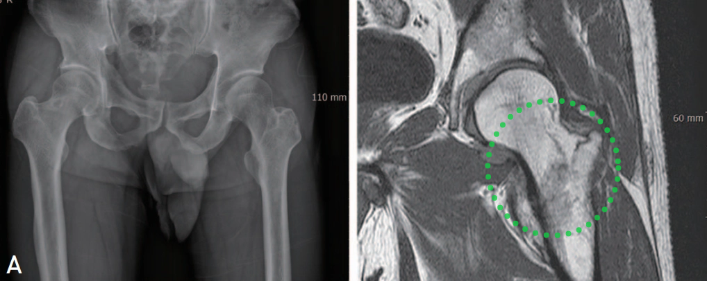 为什么需要警惕“孤立性股骨大转子骨折”？