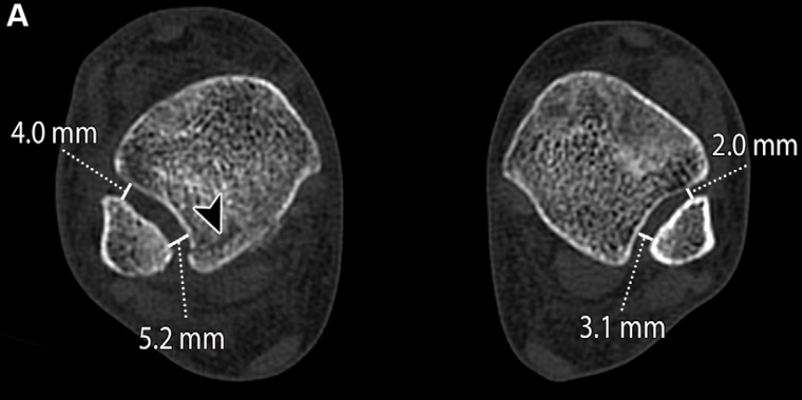 下胫腓联合损伤最全攻略｜解剖、生物力学、影像检查与术后评估