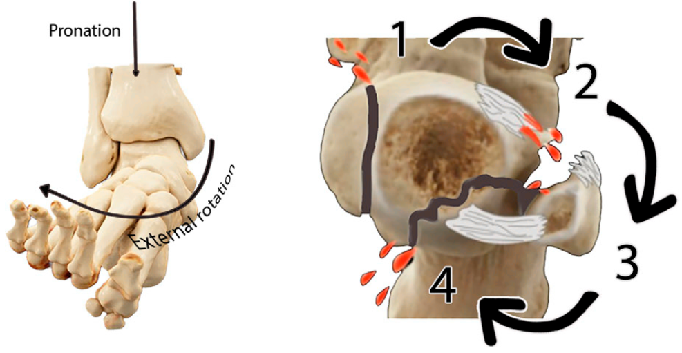 下胫腓联合损伤最全攻略｜解剖、生物力学、影像检查与术后评估