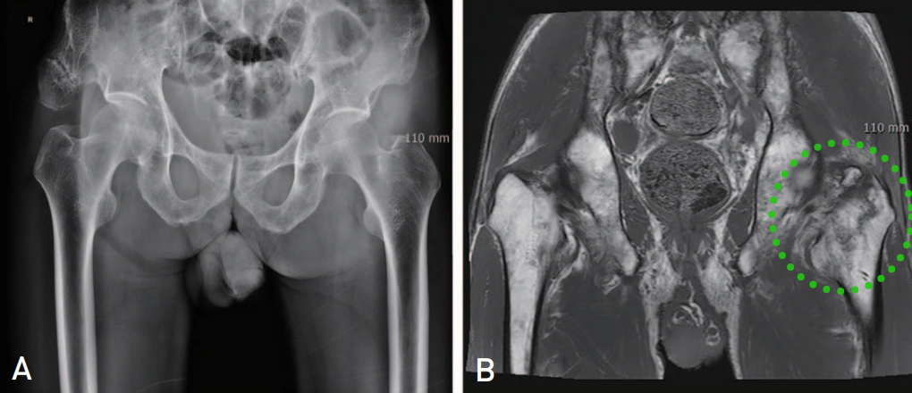 为什么需要警惕“孤立性股骨大转子骨折”？
