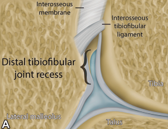 下胫腓联合损伤最全攻略｜解剖、生物力学、影像检查与术后评估