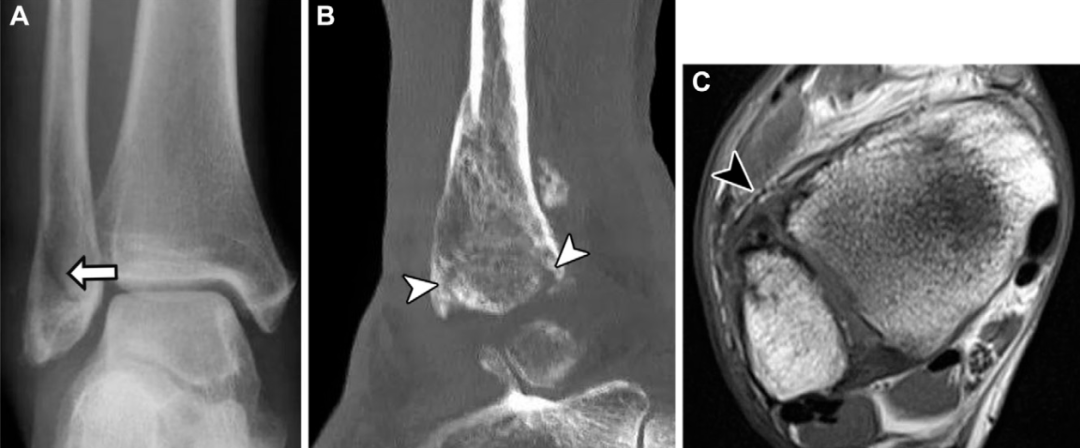下胫腓联合损伤最全攻略｜解剖、生物力学、影像检查与术后评估