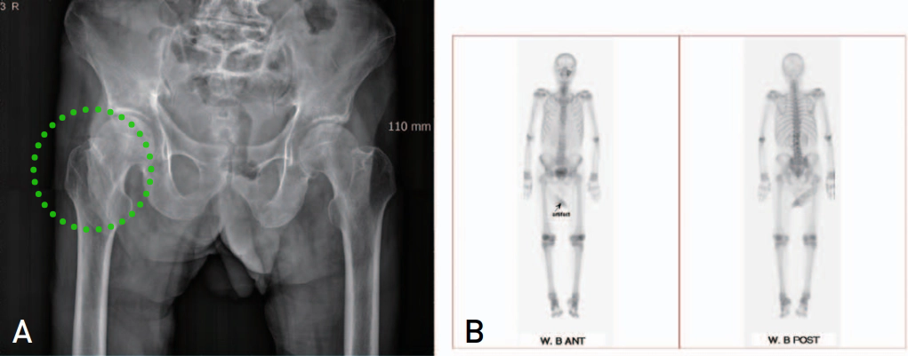 为什么需要警惕“孤立性股骨大转子骨折”？