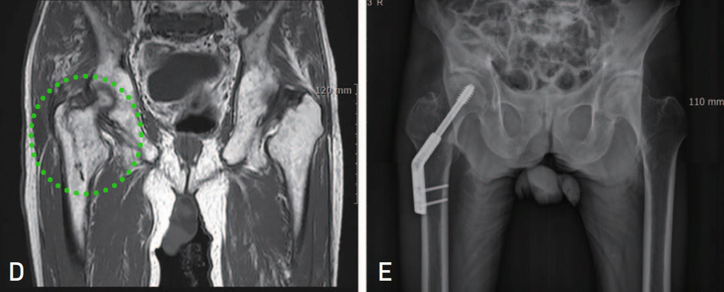 为什么需要警惕“孤立性股骨大转子骨折”？