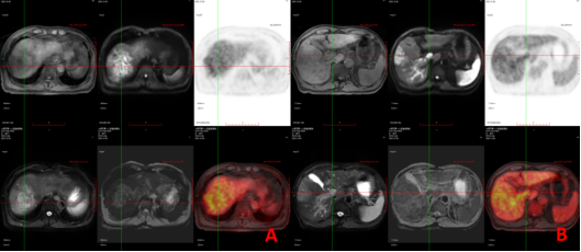 医疗 mr是什么PET／MR---引领我们进入更安全和精准高效的医疗新时代_https://www.jmylbn.com_新闻资讯_第2张