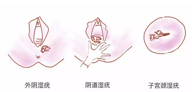 二氧化碳(co2)激光治疗是什么【苏州市中医医院丨科普园地】妇科CO2激光治疗，让你重获光彩！_https://www.jmylbn.com_新闻资讯_第7张