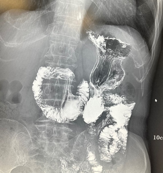 数字胃肠透视怎么做【新设备】数字胃肠机——全能型检查小助手_https://www.jmylbn.com_新闻资讯_第5张
