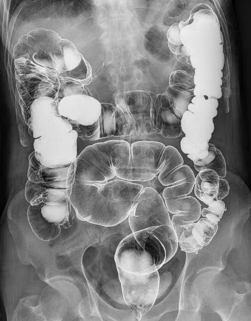数字胃肠透视怎么做【新设备】数字胃肠机——全能型检查小助手_https://www.jmylbn.com_新闻资讯_第8张