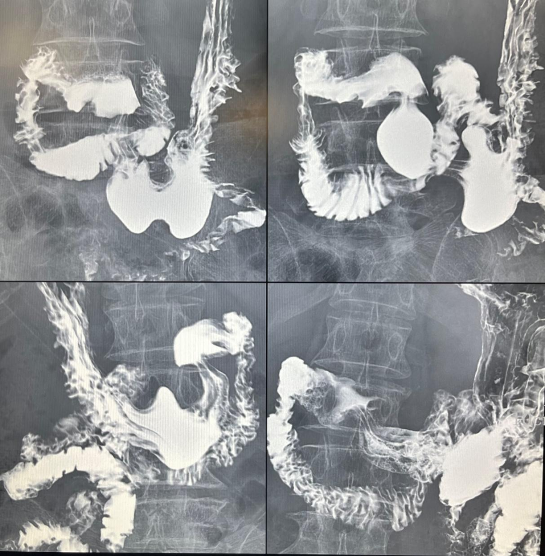数字胃肠透视怎么做【新设备】数字胃肠机——全能型检查小助手_https://www.jmylbn.com_新闻资讯_第6张
