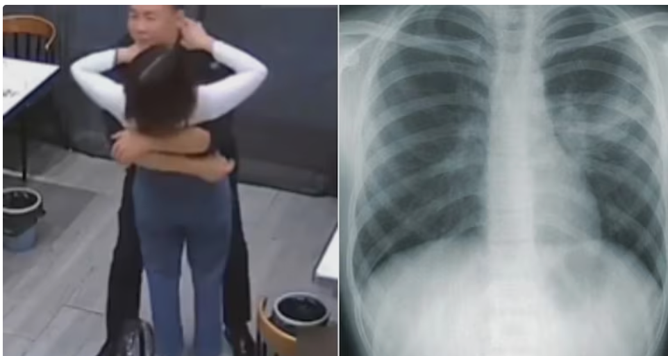 Jiangsu Woman Breaks 5 Ribs in Husband's Hug, Revealing Osteoporosis