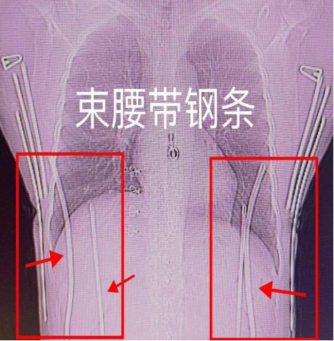 x光材质怎么调【科普加油站】放射检查穿对衣服，让健康“一目了然”_https://www.jmylbn.com_新闻资讯_第8张