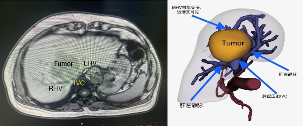 【扩散】泸州男子切肝?