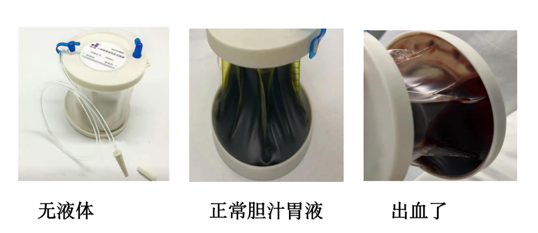 胃管有什么用内镜手术后放胃管你知道有什么作用吗？_https://www.jmylbn.com_新闻资讯_第6张