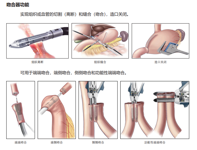 医疗吻合器是什么医疗器械宣传周 ｜ 吻合器的知识_https://www.jmylbn.com_新闻资讯_第6张