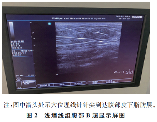 b超md是什么意思腹型肥胖兼便秘？B超下不同层次穴位埋线见疗效_https://www.jmylbn.com_新闻资讯_第2张