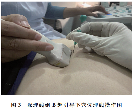 b超md是什么意思腹型肥胖兼便秘？B超下不同层次穴位埋线见疗效_https://www.jmylbn.com_新闻资讯_第3张