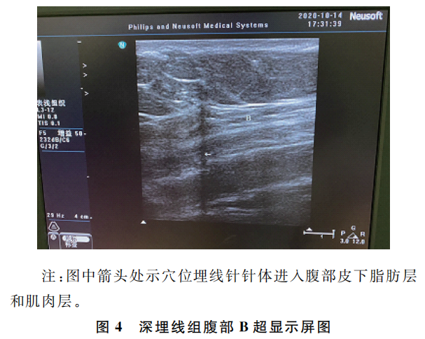b超md是什么意思腹型肥胖兼便秘？B超下不同层次穴位埋线见疗效_https://www.jmylbn.com_新闻资讯_第4张