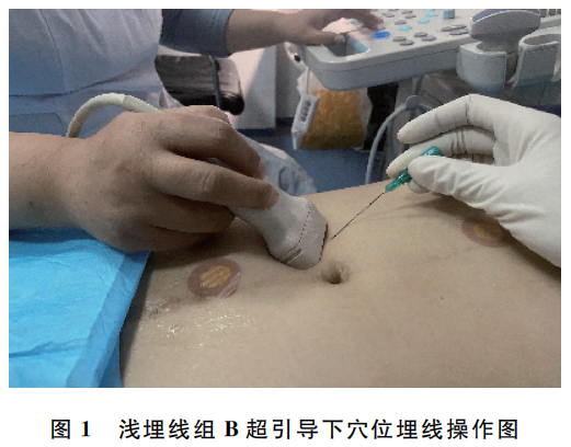 b超md是什么意思腹型肥胖兼便秘？B超下不同层次穴位埋线见疗效_https://www.jmylbn.com_新闻资讯_第1张