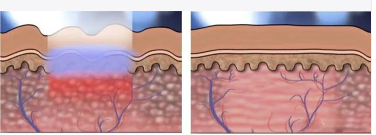 激光治疗仪能治什么病妇科“秘密武器”——激光治疗仪，做无“病”女人_https://www.jmylbn.com_新闻资讯_第4张