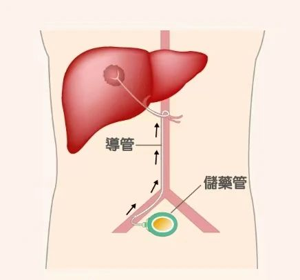 电子输注泵起什么作用输液港只能静脉输液吗？它用途可大了！_https://www.jmylbn.com_新闻资讯_第5张