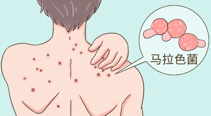 马拉色菌毛囊炎：病因、症状与防治策略