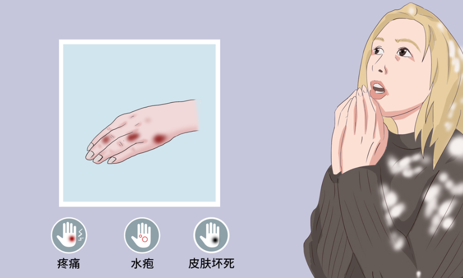 冻疮又痒又肿怎么办听听南京皮肤病医院弓娟琴教授建议