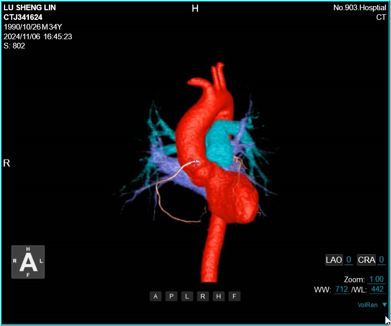 联影有哪些CT患者福音，再添利器！第903医院引进联影160排320层UCT天河860高端螺旋CT_https://www.jmylbn.com_新闻资讯_第8张