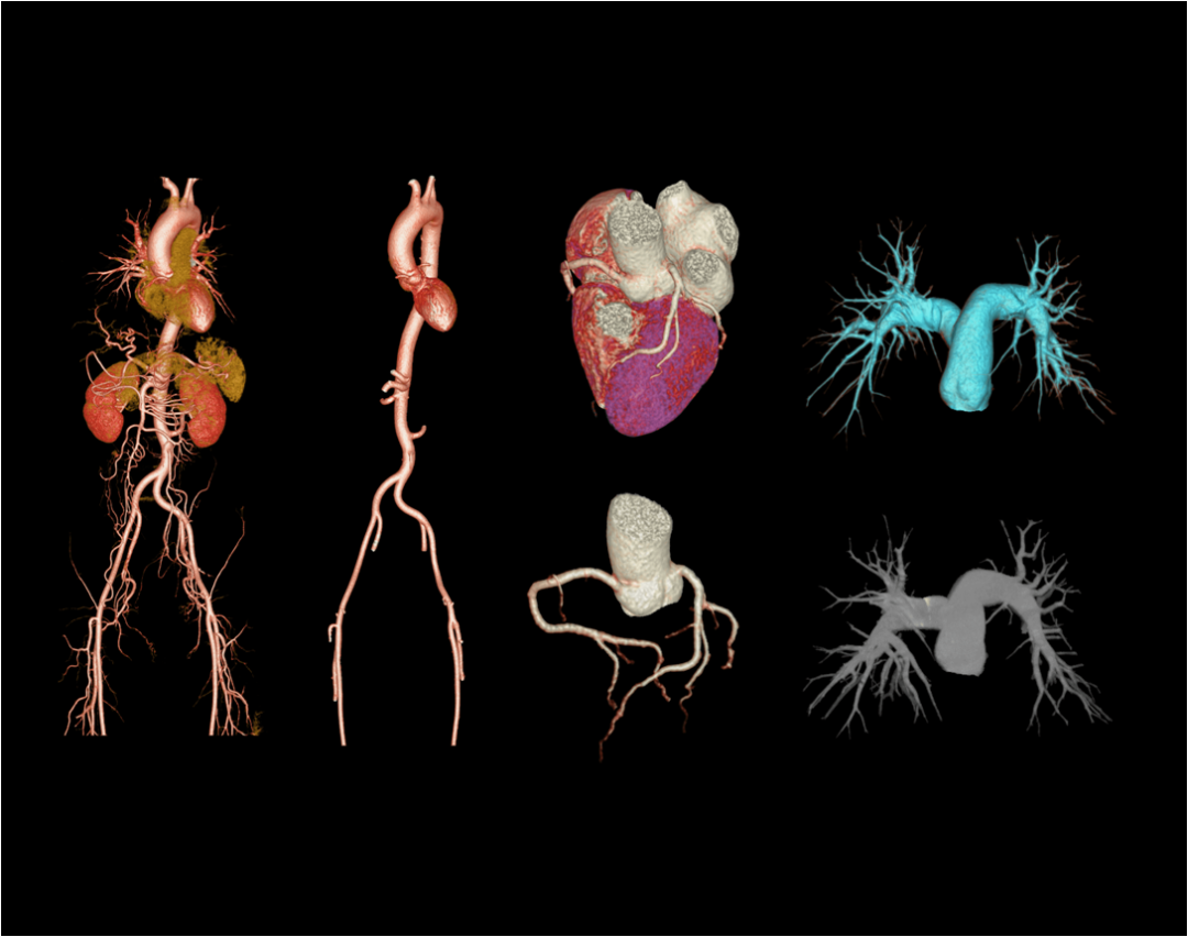 联影有哪些CT患者福音，再添利器！第903医院引进联影160排320层UCT天河860高端螺旋CT_https://www.jmylbn.com_新闻资讯_第15张
