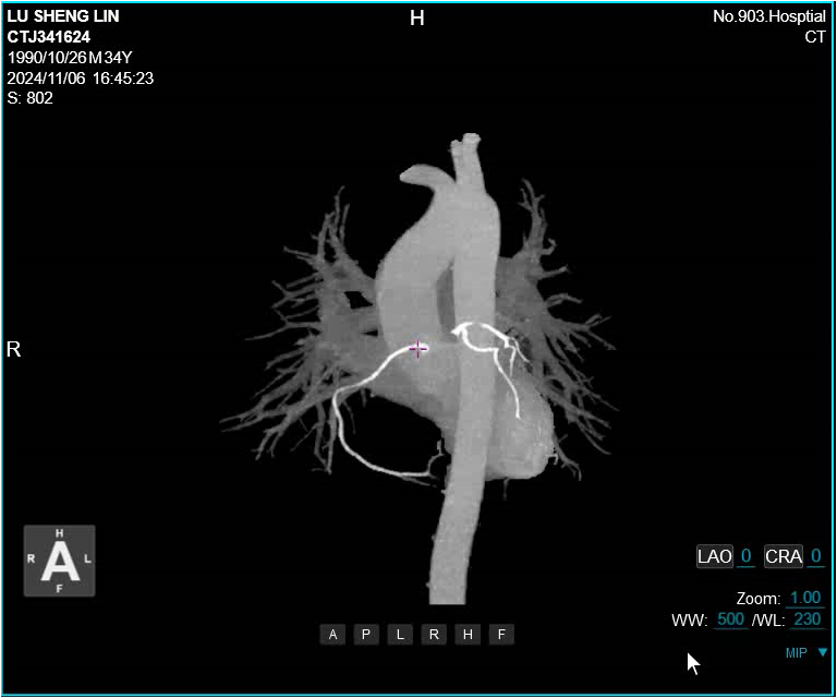 联影有哪些CT患者福音，再添利器！第903医院引进联影160排320层UCT天河860高端螺旋CT_https://www.jmylbn.com_新闻资讯_第9张
