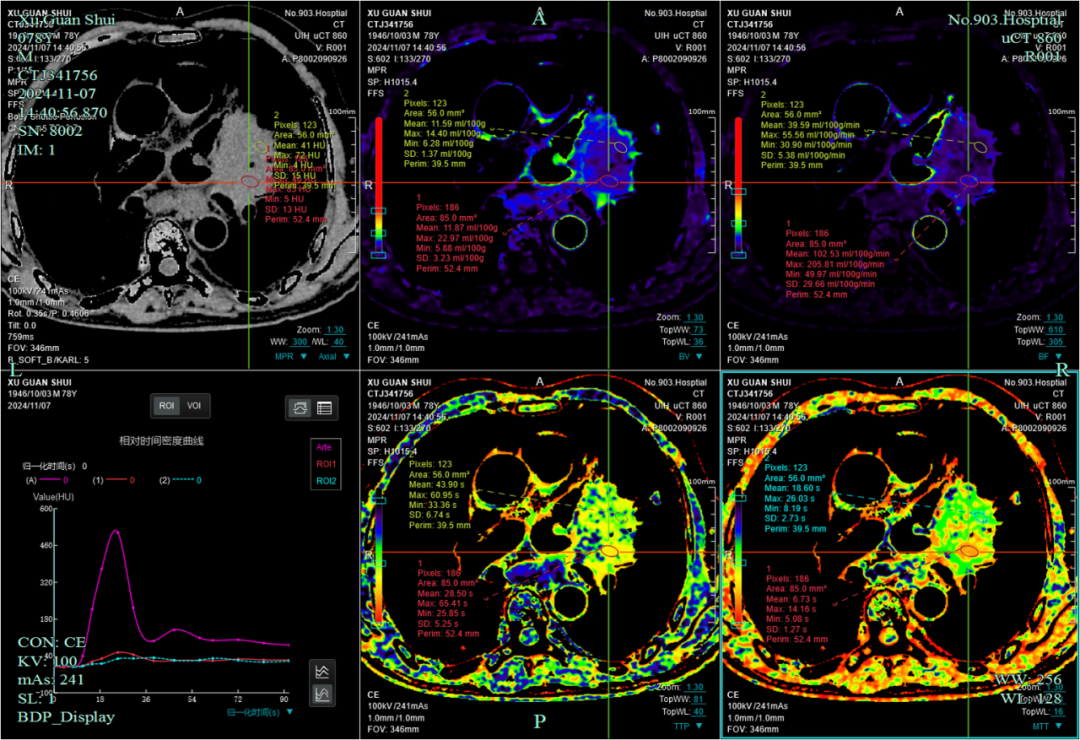 联影有哪些CT患者福音，再添利器！第903医院引进联影160排320层UCT天河860高端螺旋CT_https://www.jmylbn.com_新闻资讯_第14张