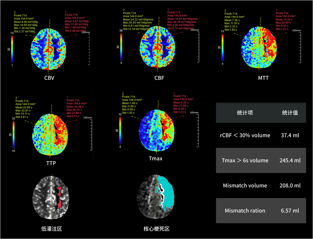 联影有哪些CT患者福音，再添利器！第903医院引进联影160排320层UCT天河860高端螺旋CT_https://www.jmylbn.com_新闻资讯_第11张