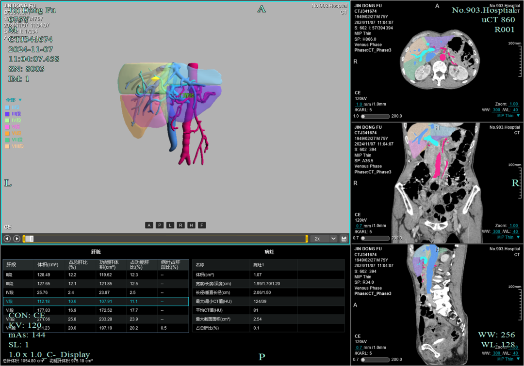 联影有哪些CT患者福音，再添利器！第903医院引进联影160排320层UCT天河860高端螺旋CT_https://www.jmylbn.com_新闻资讯_第13张