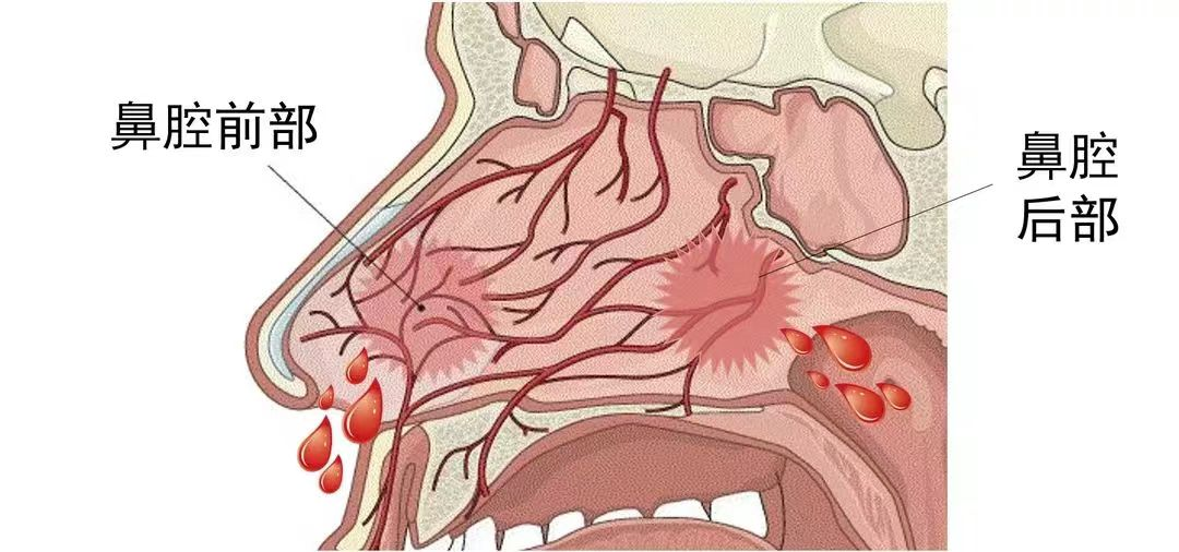 什么是电凝止血【关爱患者】鼻出血如何正确处理？电凝止血是什么？_https://www.jmylbn.com_新闻资讯_第7张