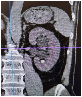 输尿管鞘是什么名医动态｜以柔克刚，无创取石——我院泌尿外科开展可弯曲负压吸引鞘+输尿管软镜钬激光碎石术_https://www.jmylbn.com_新闻资讯_第2张