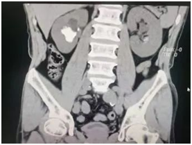 输尿管鞘是什么名医动态｜以柔克刚，无创取石——我院泌尿外科开展可弯曲负压吸引鞘+输尿管软镜钬激光碎石术_https://www.jmylbn.com_新闻资讯_第4张