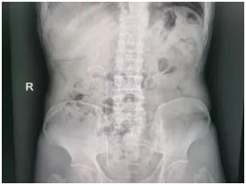 输尿管鞘是什么名医动态｜以柔克刚，无创取石——我院泌尿外科开展可弯曲负压吸引鞘+输尿管软镜钬激光碎石术_https://www.jmylbn.com_新闻资讯_第5张