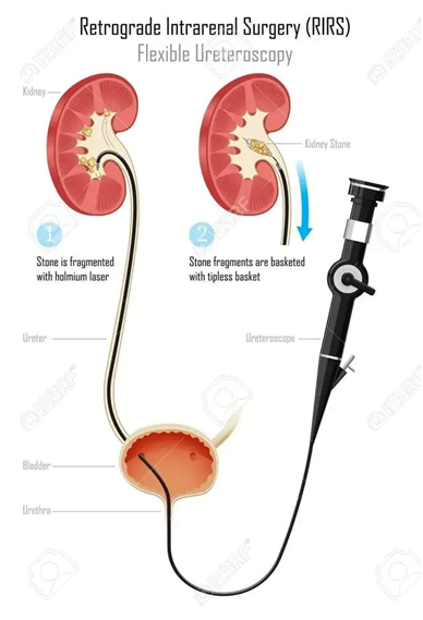 输尿管鞘是什么名医动态｜以柔克刚，无创取石——我院泌尿外科开展可弯曲负压吸引鞘+输尿管软镜钬激光碎石术_https://www.jmylbn.com_新闻资讯_第7张