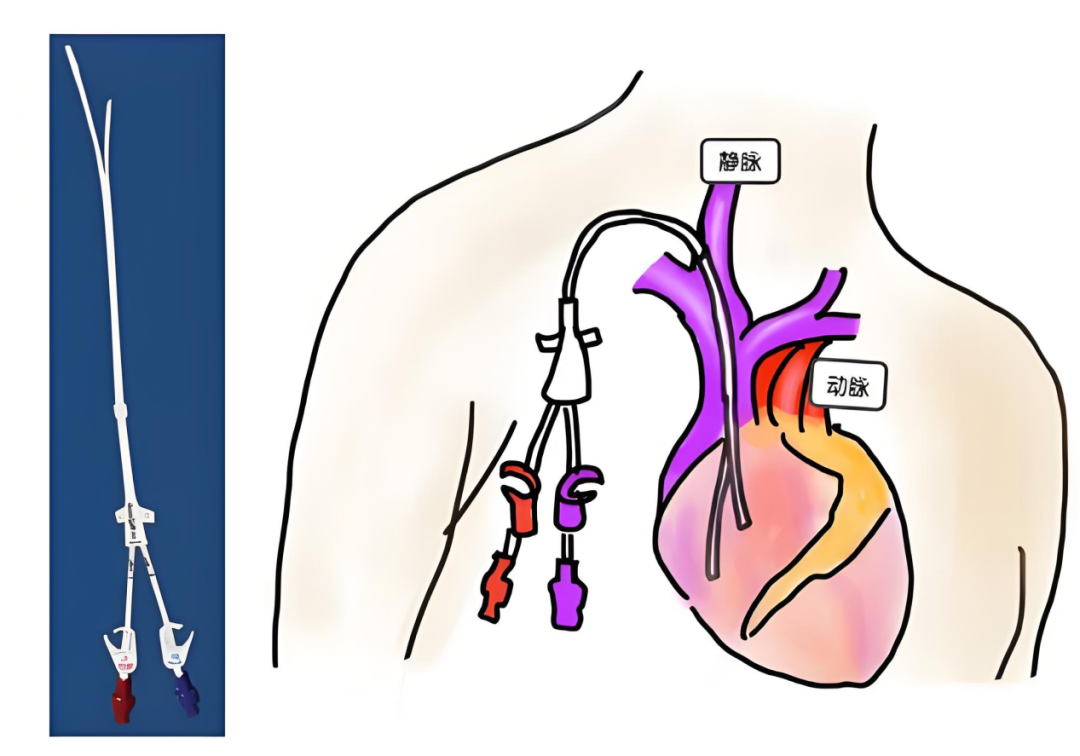 输液的器械叫什么【巩医科普】输液工具大揭秘_https://www.jmylbn.com_新闻资讯_第9张