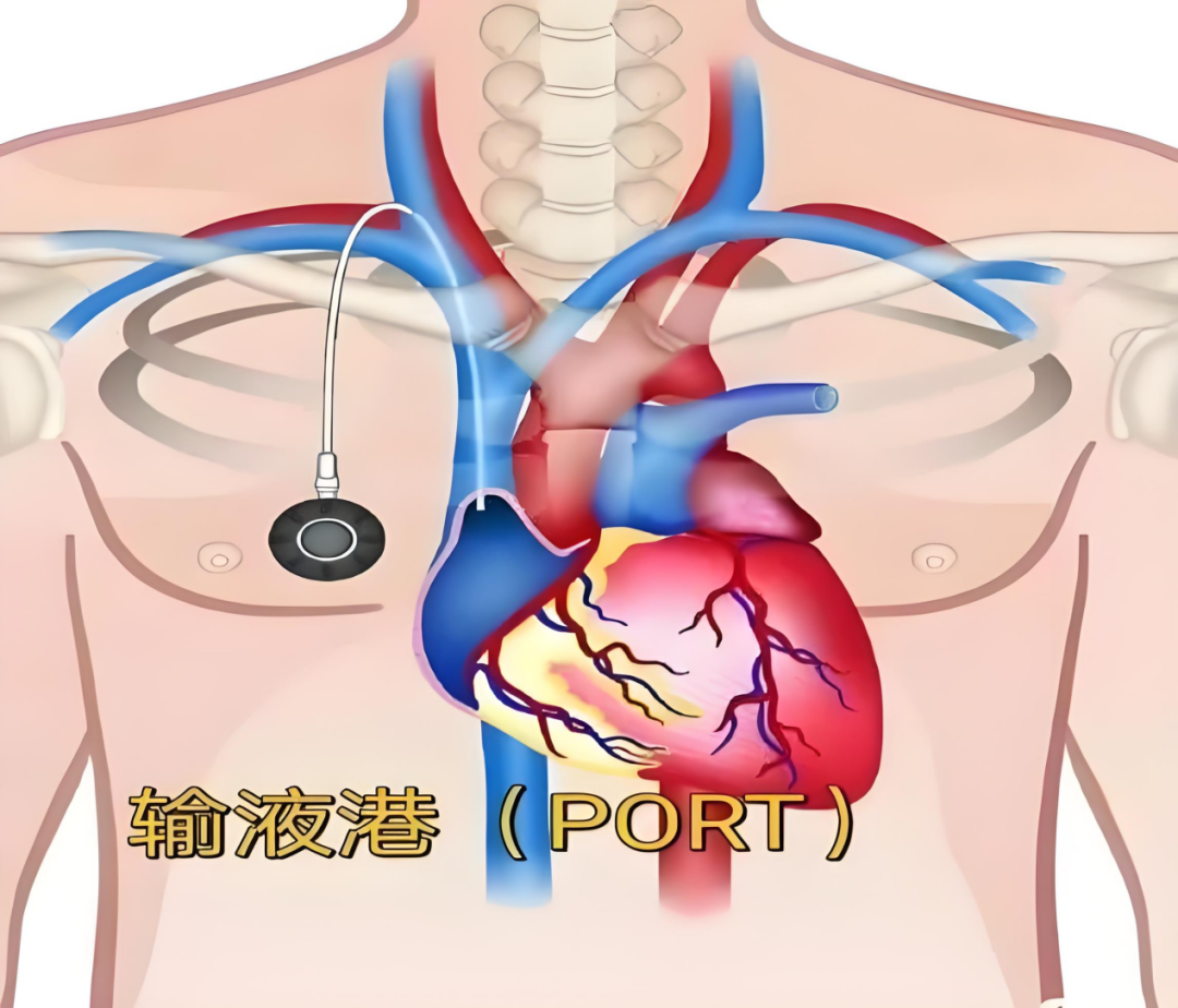 输液的器械叫什么【巩医科普】输液工具大揭秘_https://www.jmylbn.com_新闻资讯_第12张