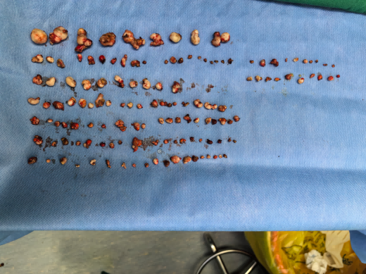 什么是结扎速血管闭合女子腹胀、腹痛以为是胃肠道不适，结果是卵巢癌！市二多学科合力诊治→_https://www.jmylbn.com_新闻资讯_第7张